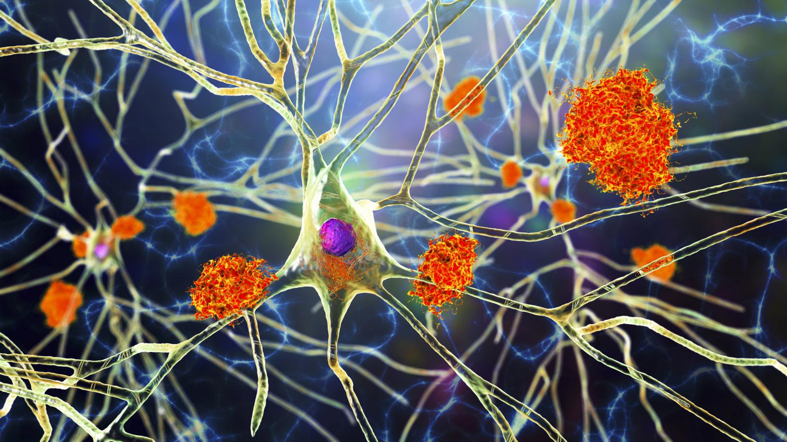 Illustration of amyloid plaques inside the brain